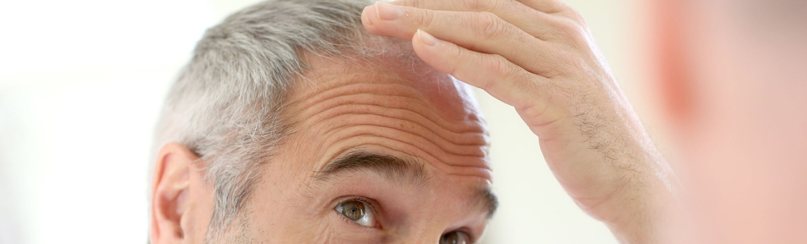 Mann betrachtet seinen Kopf nach einer Haartransplantation bei Glatze